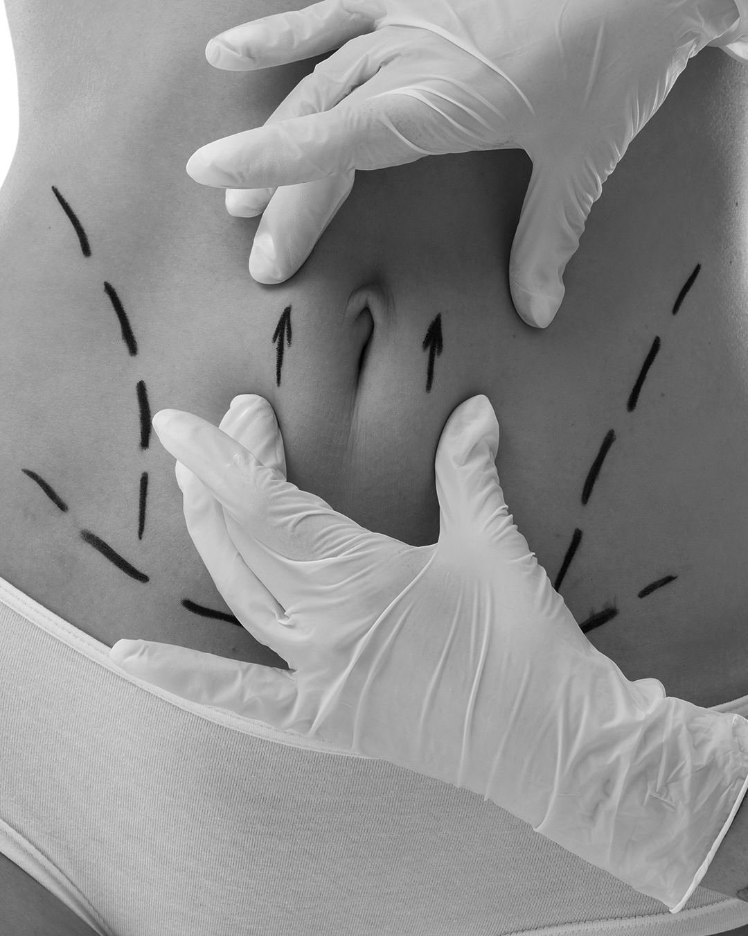Abdominoplastia