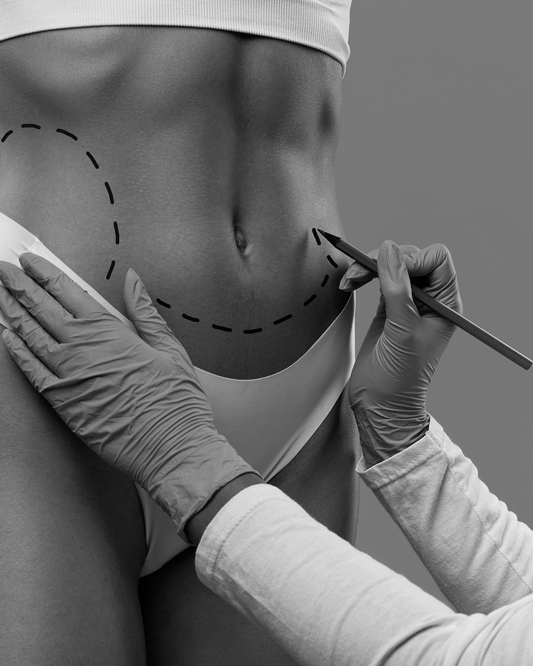 Lipoaspiração